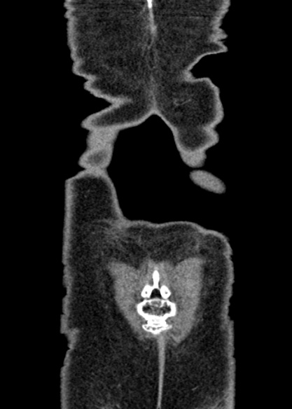 Adhesional small bowel obstruction (Radiopaedia 48397-53305 Coronal C+ portal venous phase 342).jpg