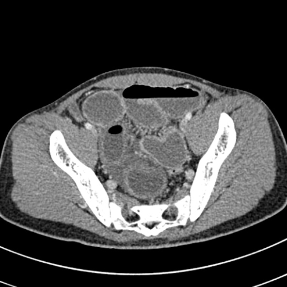 Adhesional small bowel obstruction (Radiopaedia 52107-57980 Axial C+ portal venous phase 106).jpg