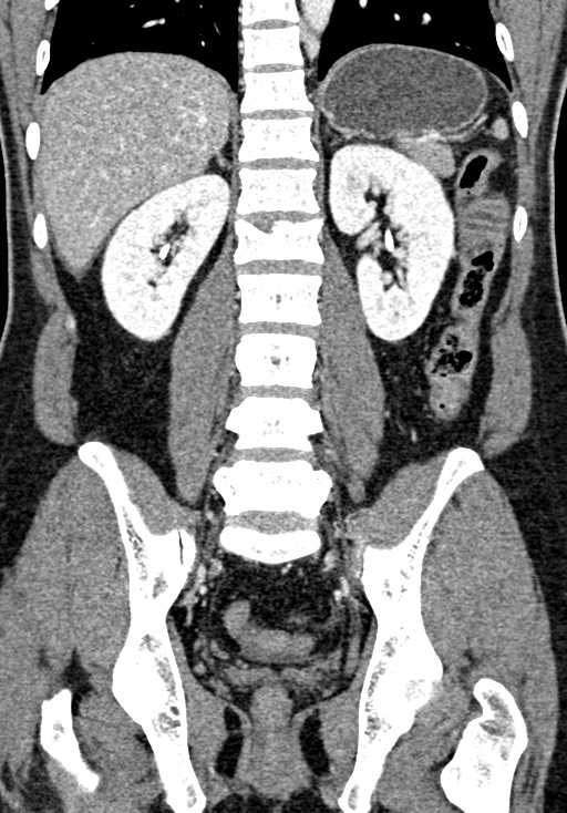 Adhesional small bowel obstruction (Radiopaedia 58900-66131 Coronal C+ portal venous phase 174).jpg