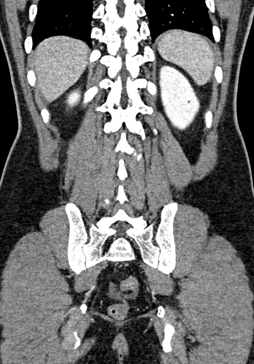 Adhesional small bowel obstruction (Radiopaedia 58900-66131 Coronal C+ portal venous phase 198).jpg