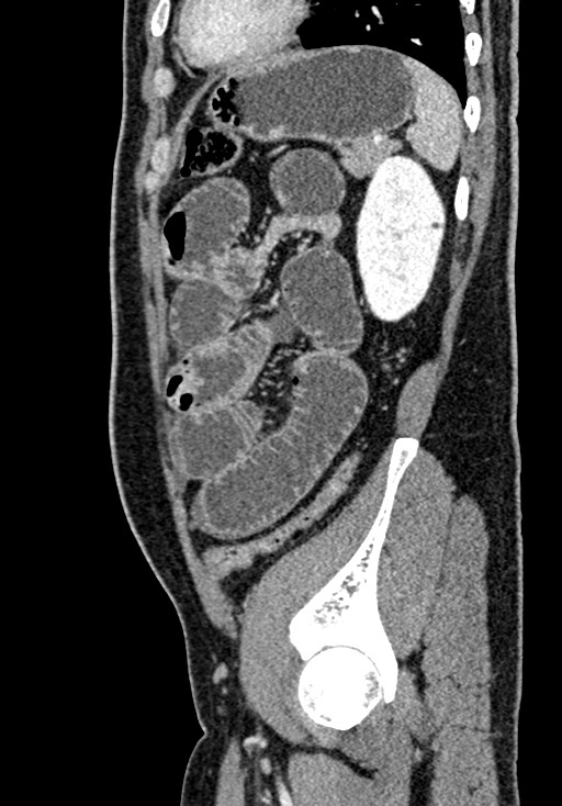 Adhesional small bowel obstruction (Radiopaedia 58900-66131 Sagittal C+ portal venous phase 192).jpg