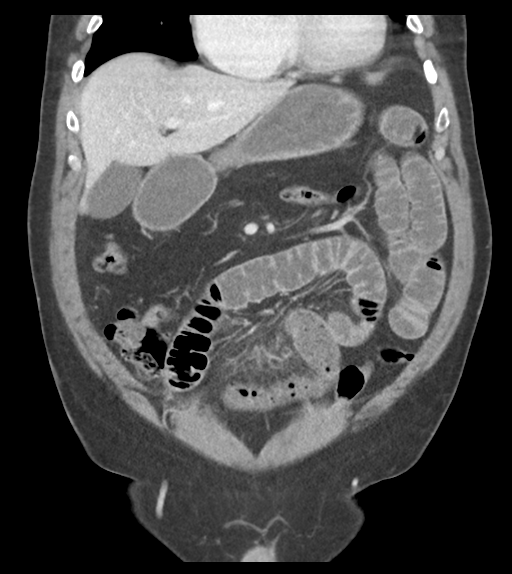 Adhesions within abdominal wall hernia (Radiopaedia 58283-65394 Coronal C+ portal venous phase 27).png