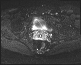 File:Adnexal multilocular cyst (O-RADS US 3- O-RADS MRI 3) (Radiopaedia 87426-103754 Axial DWI 18).jpg
