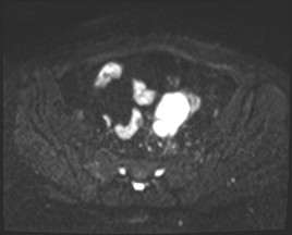 File:Adnexal multilocular cyst (O-RADS US 3- O-RADS MRI 3) (Radiopaedia 87426-103754 Axial DWI 6).jpg