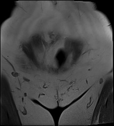 File:Adnexal multilocular cyst (O-RADS US 3- O-RADS MRI 3) (Radiopaedia 87426-103754 Coronal 2).jpg