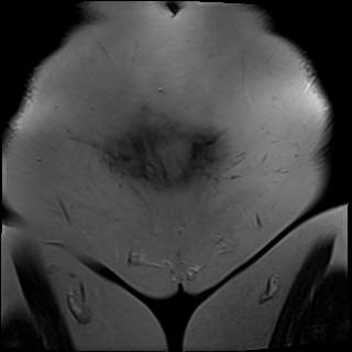 File:Adnexal multilocular cyst (O-RADS US 3- O-RADS MRI 3) (Radiopaedia 87426-103754 Coronal T2 1).jpg