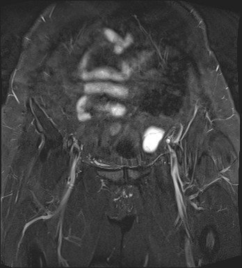 File:Adnexal multilocular cyst (O-RADS US 3- O-RADS MRI 3) (Radiopaedia 87426-103754 Coronal T2 fat sat 7).jpg