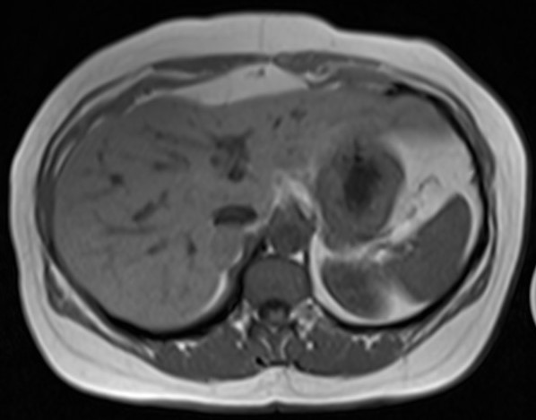File:Adrenal adenoma (chemical shift imaging) (Radiopaedia 14341-14253 Axial T1 in-phase 1).jpg