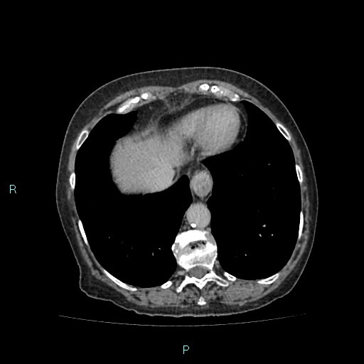 File:Adrenal collision tumor (ACT) (Radiopaedia 48462-53379 Axial C+ delayed 8).jpg