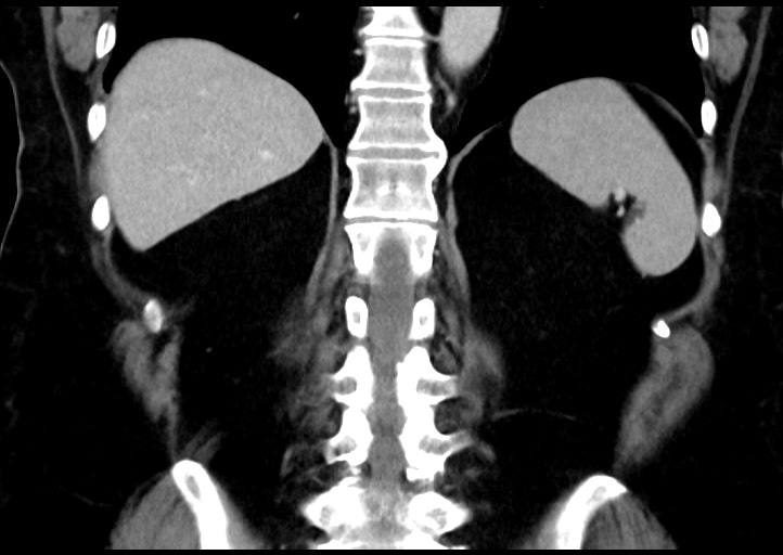 File:Adrenal cortical carcinoma (Radiopaedia 64017-72769 Coronal C+ portal venous phase 39).jpg