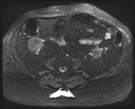 Adrenal cortical carcinoma (Radiopaedia 64017-72770 Axial DWI 80).jpg