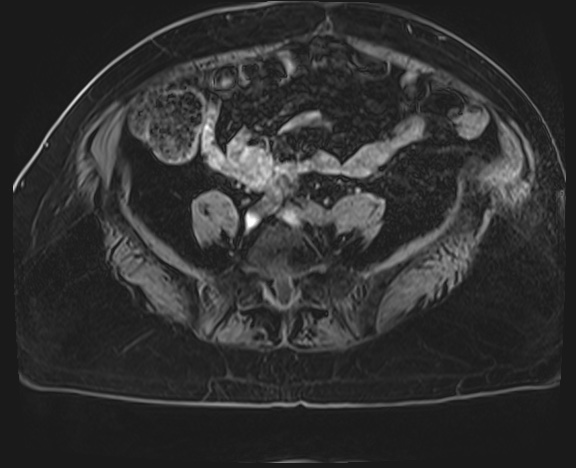 Adrenal cortical carcinoma (Radiopaedia 64017-72770 Axial T1 C+ fat sat 64).jpg