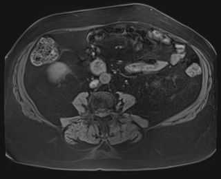 Adrenal cortical carcinoma (Radiopaedia 64017-72770 Axial T1 fat sat 62).jpg