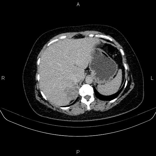 Adrenal cortical carcinoma (Radiopaedia 84882-100379 Axial C+ delayed 14).jpg