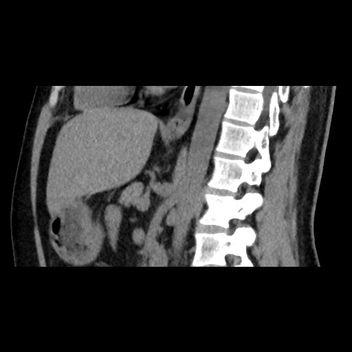 Adrenal gland trauma (Radiopaedia 81351-95079 Sagittal non-contrast 55).jpg