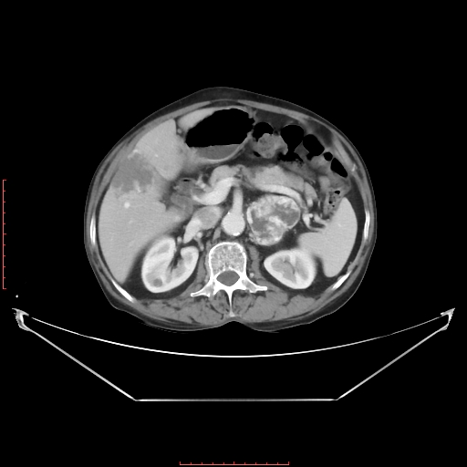 Adrenal hemangioma (Radiopaedia 68923-78668 Axial C+ portal venous phase 28).jpg