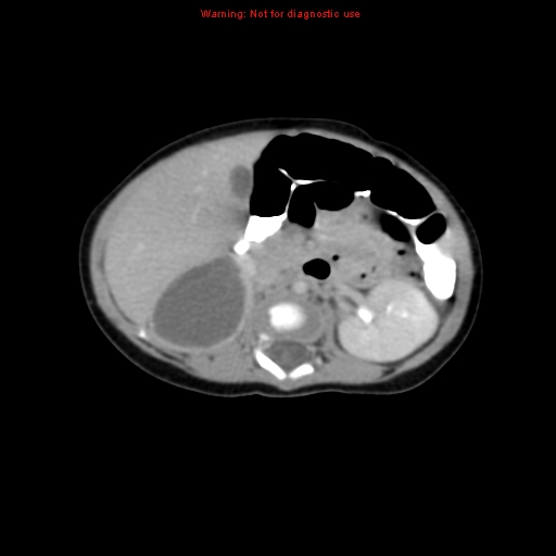File:Adrenal hemorrhage (Radiopaedia 9390-10077 Axial C+ portal venous phase 11).jpg
