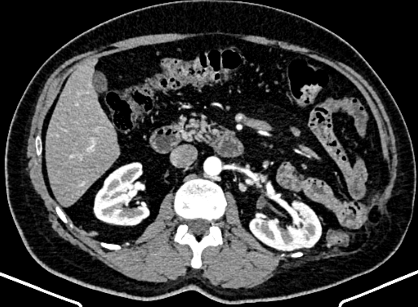 Adrenal metastases (Radiopaedia 73082-83791 Axial C+ arterial phase 74).jpg