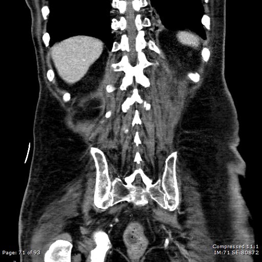 Adrenal metastasis (Radiopaedia 78425-91079 Sagittal C+ portal venous phase 58).jpg