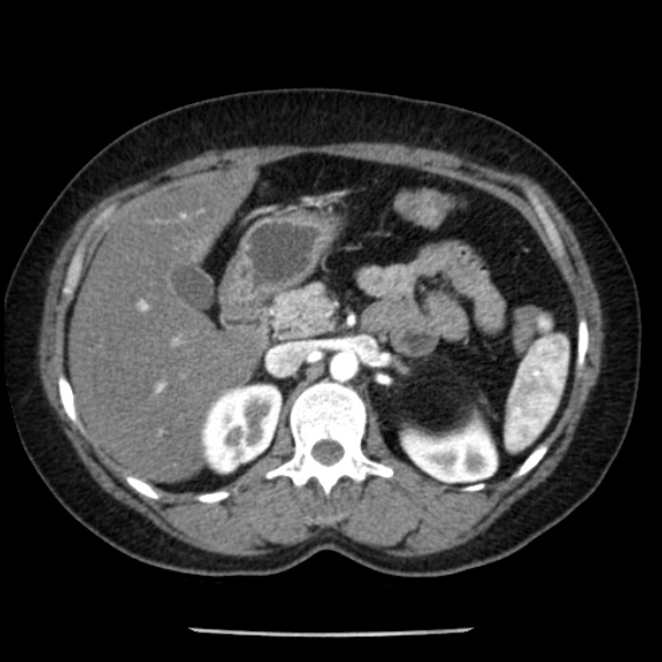 Adrenal myelolipoma (Radiopaedia 43401-46759 Axial C+ arterial phase 35).jpg