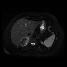 File:Adrenal myelolipoma - MRI (Radiopaedia 83249-97646 Axial STIR 11).jpg