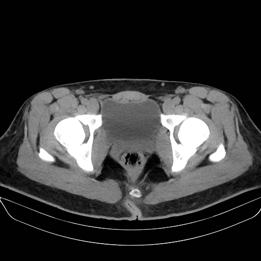 File:Adrenal myelolipoma - bilateral (Radiopaedia 74805-85810 Axial non-contrast 80).jpg