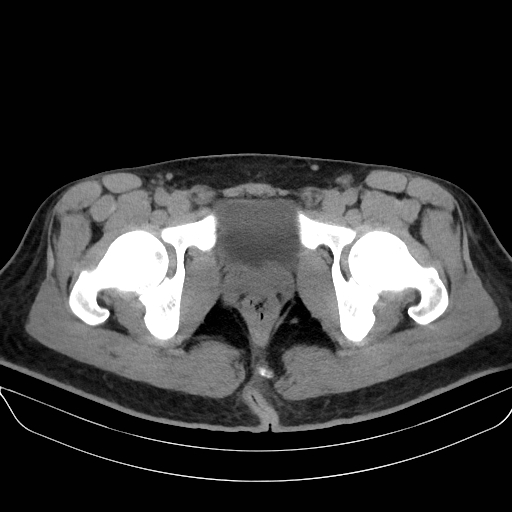 Adrenal myelolipoma - bilateral (Radiopaedia 74805-85810 Axial non-contrast 82).jpg
