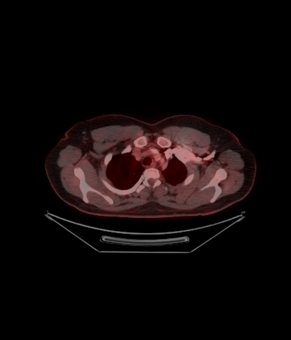 Adrenocortical carcinoma (Radiopaedia 80134-93440 ِAxial 92).jpg