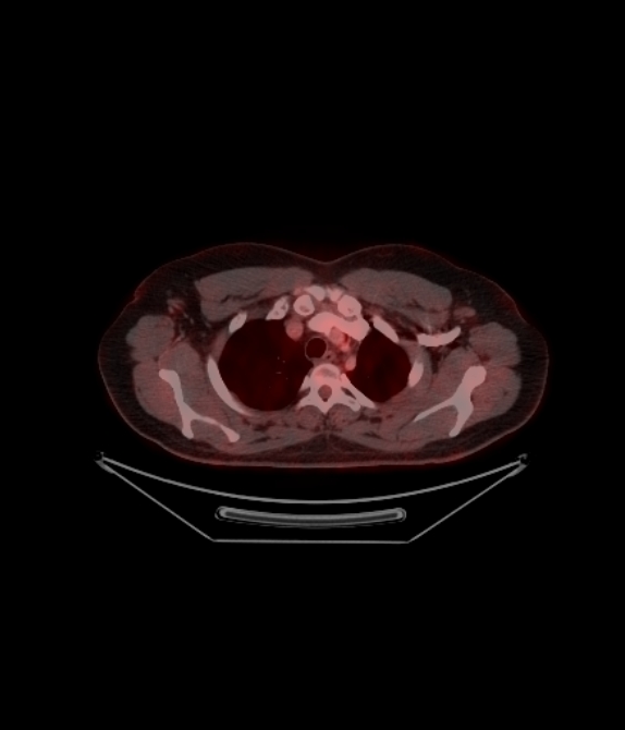 Adrenocortical carcinoma (Radiopaedia 80134-93440 ِAxial 94).jpg