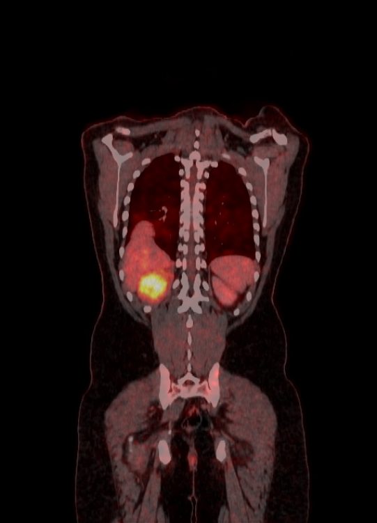 Adrenocortical carcinoma (Radiopaedia 80134-93440 Coronal 151).jpg
