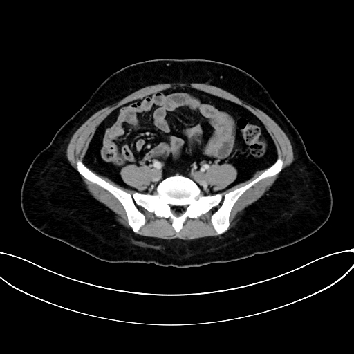 File:Adrenocortical carcinoma (Radiopaedia 87281-103569 Axial C+ portal venous phase 61).jpg