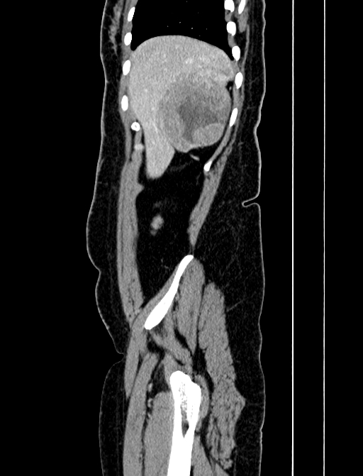 Adrenocortical carcinoma (Radiopaedia 87281-103569 Sagittal C+ portal venous phase 27).jpg