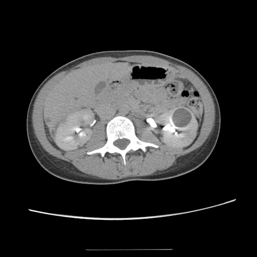 Adult polycystic kidney disease (Radiopaedia 48845-53876 Axial renal excretory phase 44).jpg