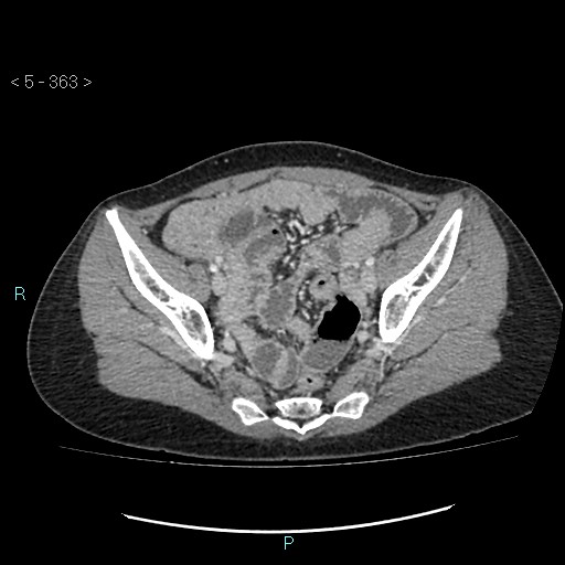 Adult transient intestinal intussusception (Radiopaedia 34853-36310 Axial C+ portal venous phase 91).jpg