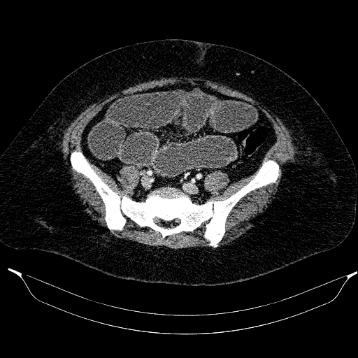 File:Afferent loop syndrome - secondary to incarcerated trocar site hernia (Radiopaedia 82959-97305 Axial C+ portal venous phase 172).jpg
