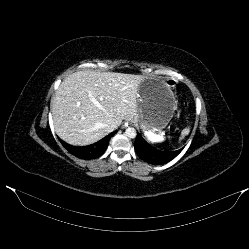 File:Afferent loop syndrome - secondary to incarcerated trocar site hernia (Radiopaedia 82959-97305 Axial C+ portal venous phase 40).jpg
