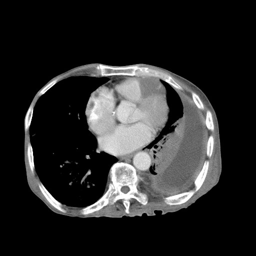 File:Aggressive lung cancer with cardiac metastases, pulmonary artery tumor thrombus, and Budd-Chiari (Radiopaedia 60320-67981 A 36).jpg