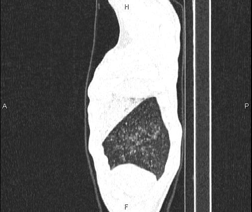 Air bronchogram in pneumonia (Radiopaedia 85719-101512 Sagittal lung window 9).jpg