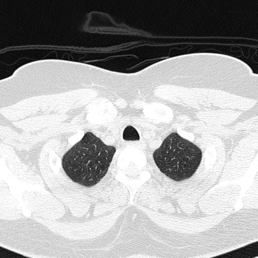 Air trapping in small airway disease (Radiopaedia 61685-69694 Axial lung window 17).jpg