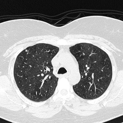 Air trapping in small airway disease (Radiopaedia 61685-69694 Axial lung window 52).jpg