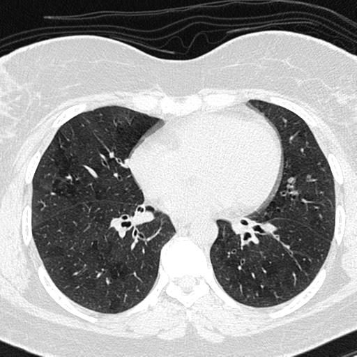 Air trapping in small airway disease (Radiopaedia 61685-69694 Axial lung window 99).jpg