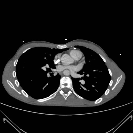 File:Alagille syndrome with pulmonary hypertension (Radiopaedia 49384-54980 A 7).jpg