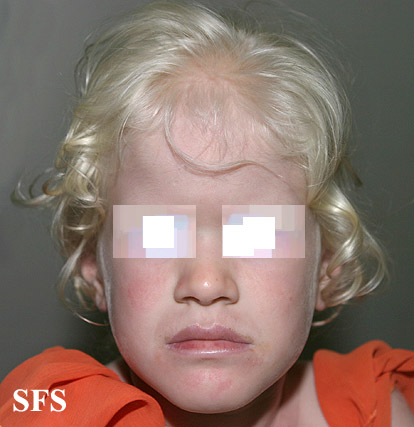 Albinism (Dermatology Atlas 1).jpg