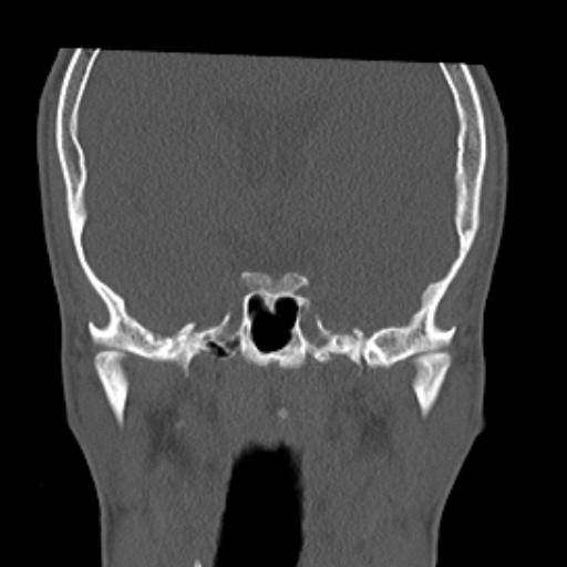 File:Allergic fungal sinusitis (Radiopaedia 29086-29455 Coronal bone window 3).jpg