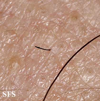 Alopecia Areata (Dermatology Atlas 60).jpg
