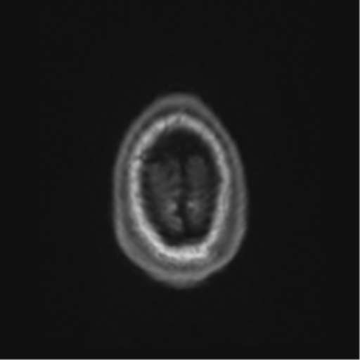 File:Alzheimer's disease- with Gerstmann syndrome and dressing apraxia (Radiopaedia 54882-61150 Axial T1 74).png