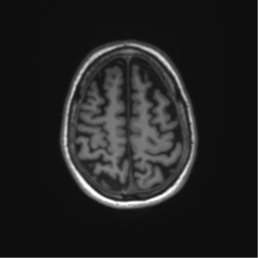 File:Alzheimer's disease (Radiopaedia 42658-45802 Axial T1 36).png