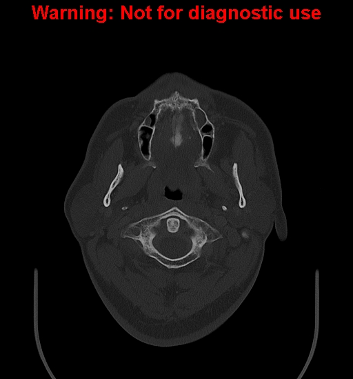 File:Ameloblastoma (Radiopaedia 33126-34164 Axial bone window 4).jpg