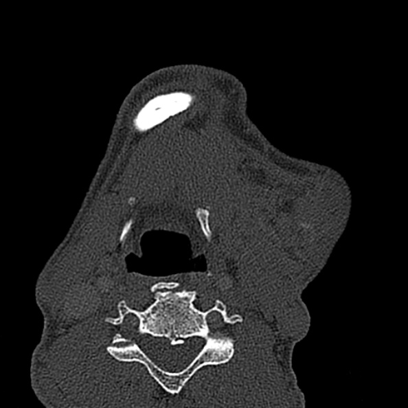 Ameloblastoma (Radiopaedia 51921-57766 Axial bone window 19).jpg