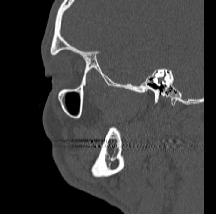 Ameloblastoma (Radiopaedia 77750-89997 Sagittal bone window 81).jpg